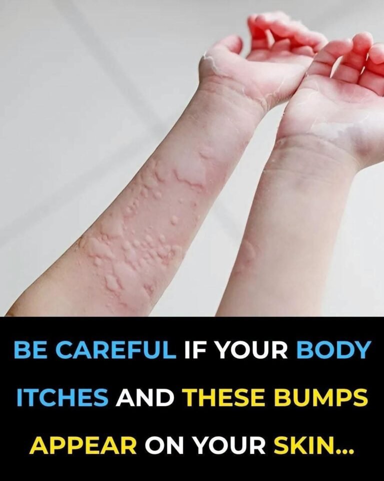 Surprising Causes of Hives Revealed: What May Be Triggering Your Skin Reaction