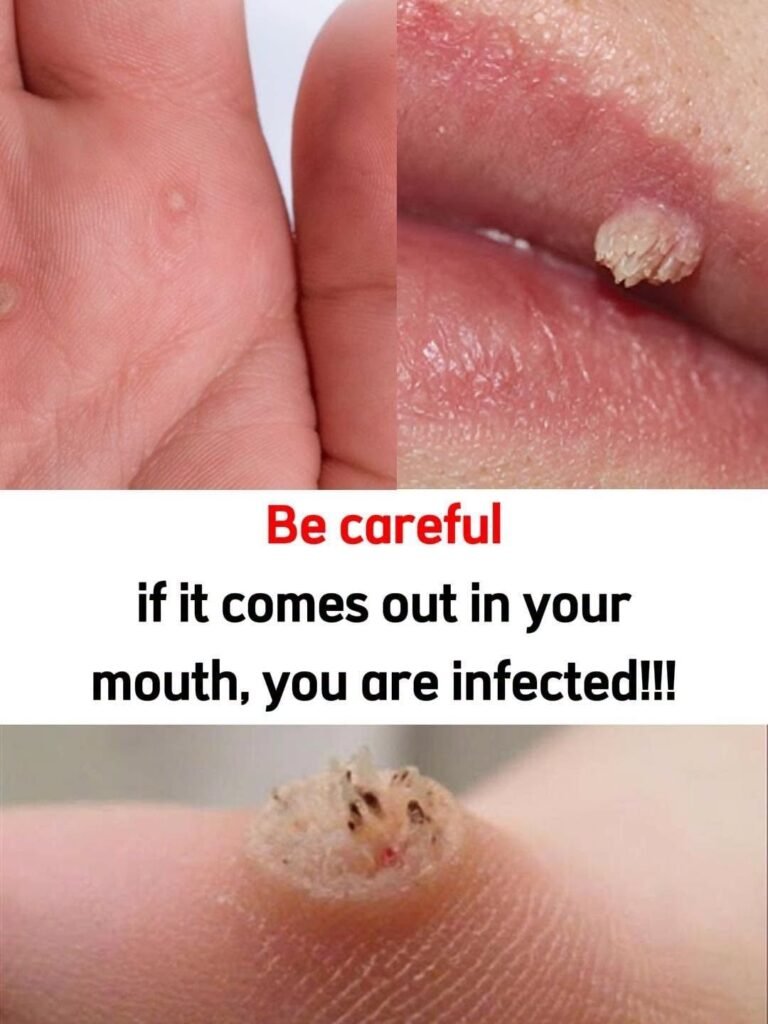 You Have Been Ignoring These Wart Removal Tricks for Years, Doctors Say Some Actually Work But There Is a Catch