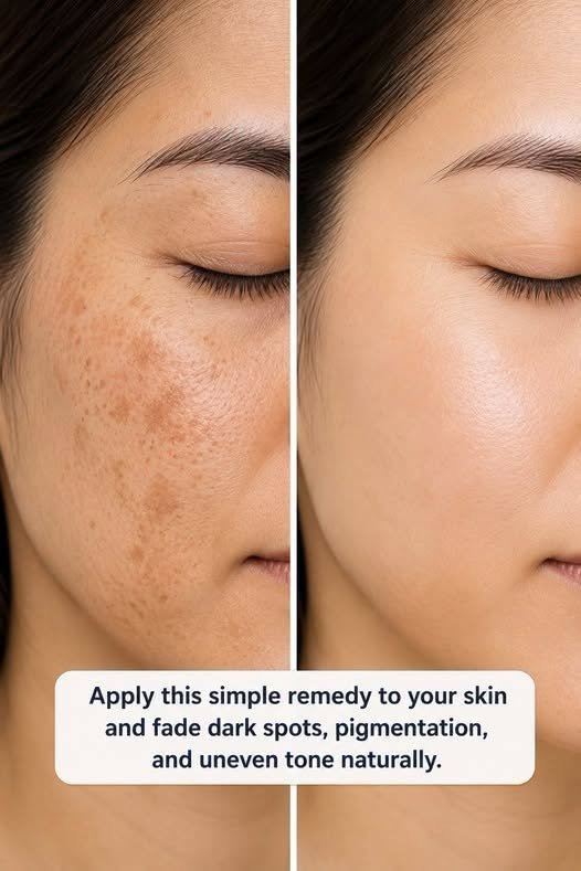 Rub This 1 Mixture on Your Cheeks and Get Rid of Dark Patches, Uneven Skin Tone, and Melasma