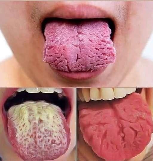 If Your Tongue Is White , this is a clear sign that you are suffering from…